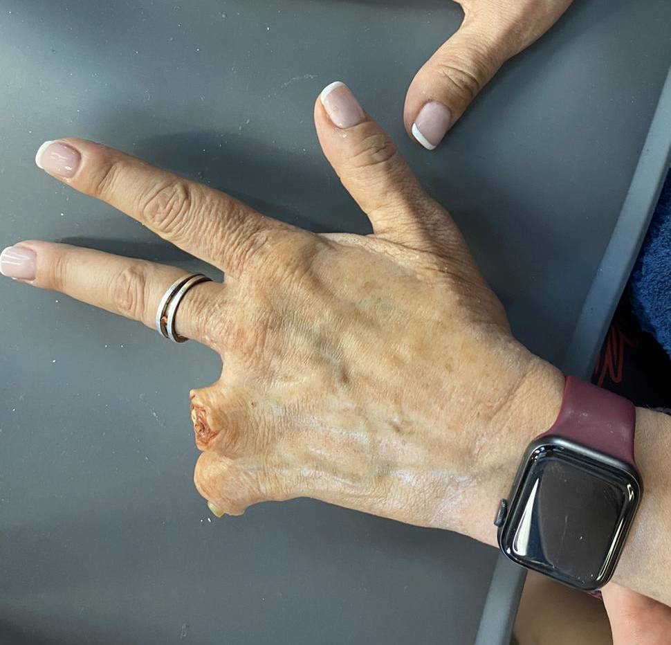 Prótesis de mano para Día de caza
